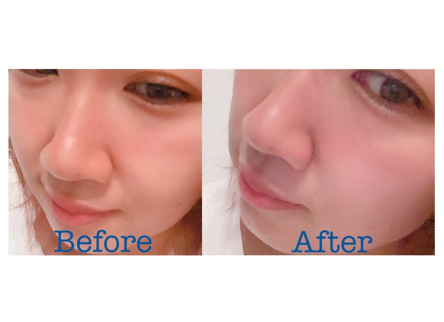 チョコブラ スペシャル毛穴ケアセット/Chocobra/スキンケアキットを使ったクチコミ(7枚目)