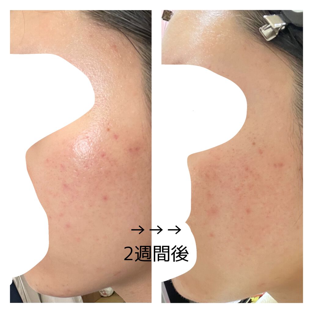 ディフェリンゲル0.1% /マルホ株式会社/その他を使ったクチコミ（3枚目）