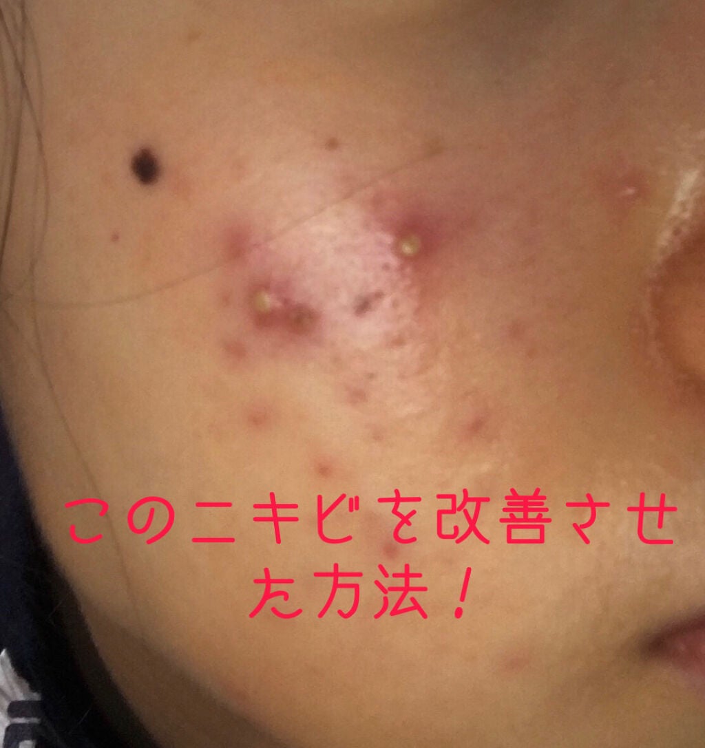 スキンピールバー AHAマイルド/サンソリット/洗顔石鹸を使ったクチコミ(1枚目)