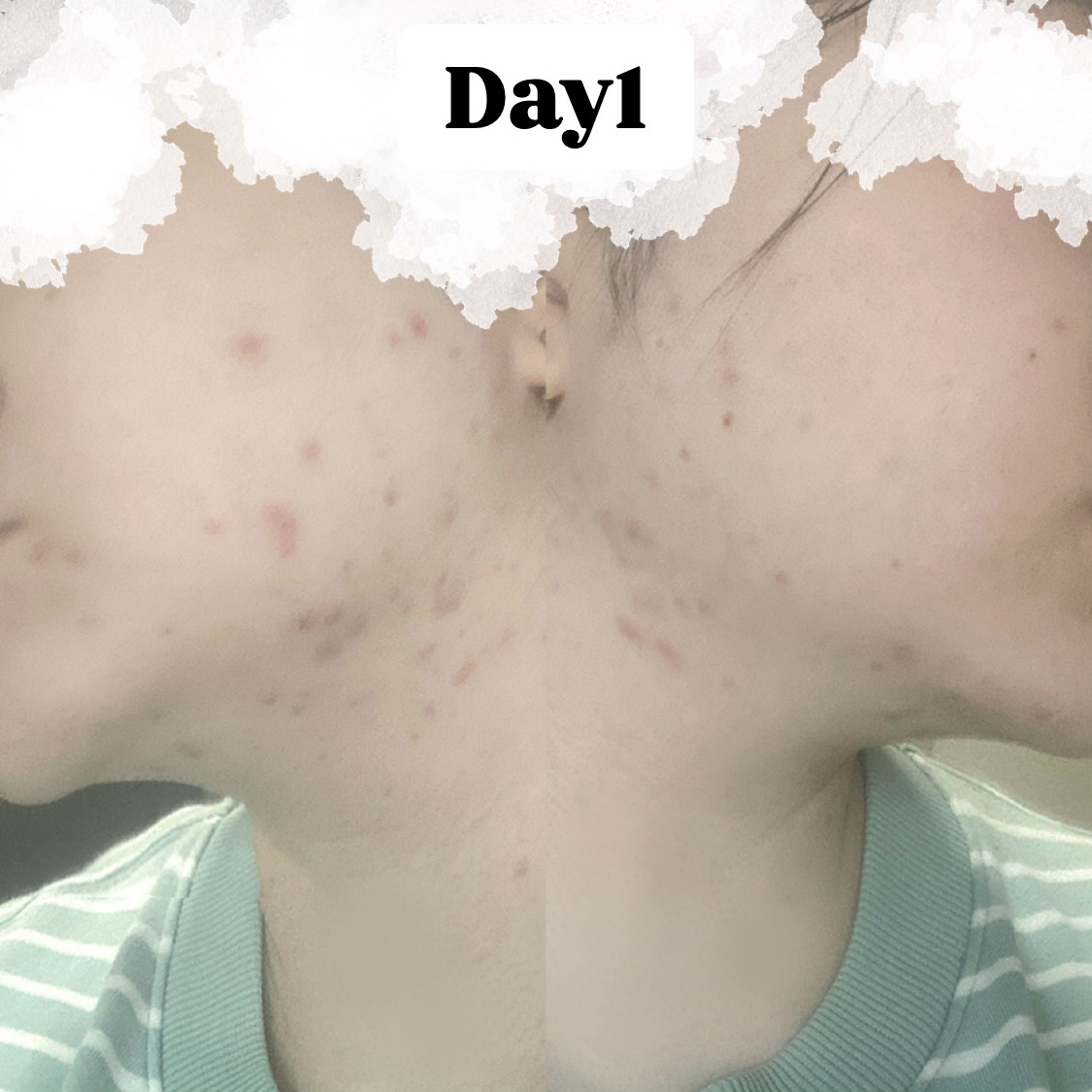 ペアアクネクリームW(医薬品)/ペア/その他を使ったクチコミ（2枚目）