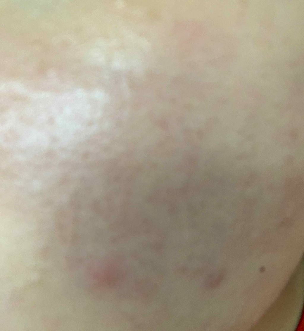 エピデュオゲル/マルホ株式会社/その他を使ったクチコミ（1枚目）