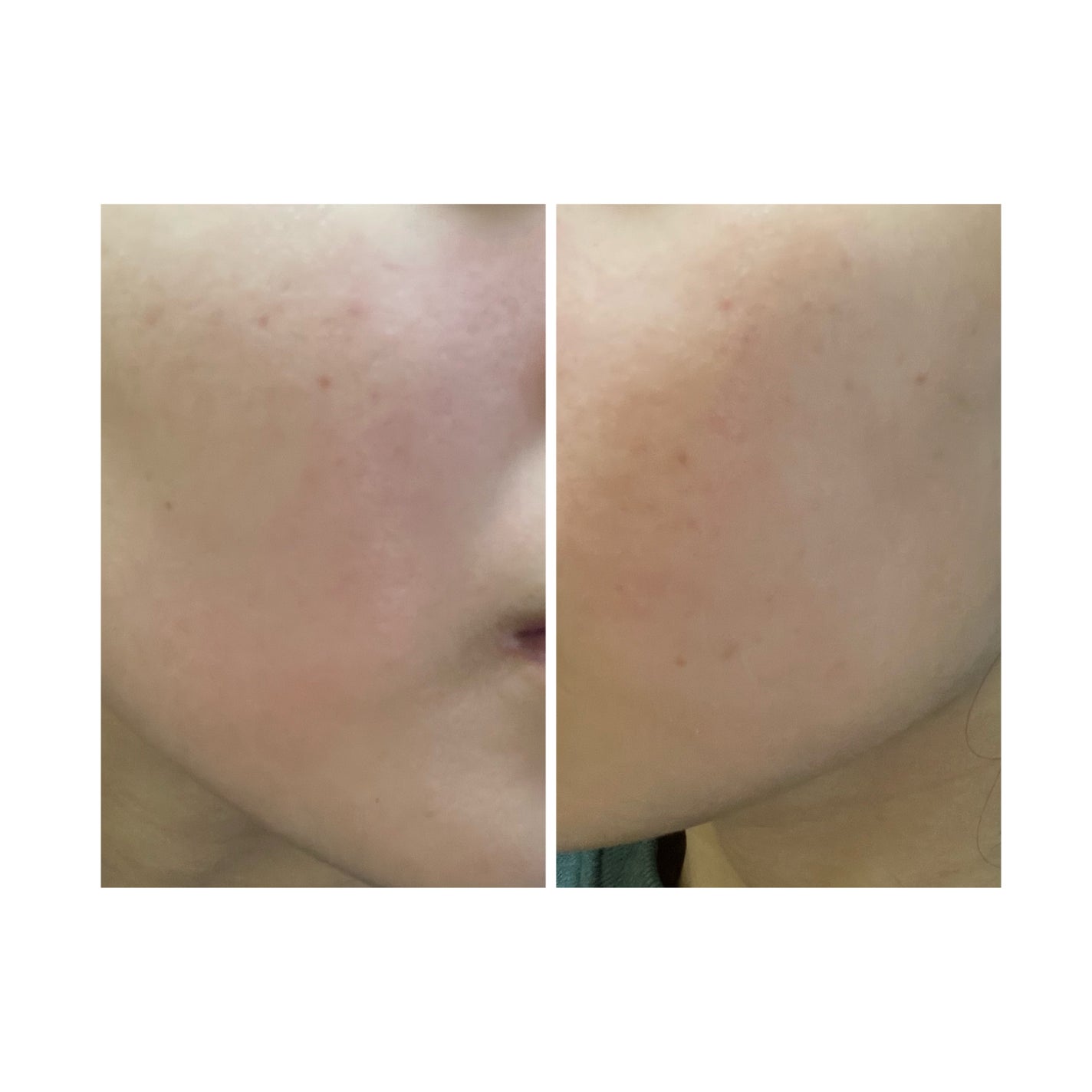 ぽむ on LIPS 「2023.9.13皮膚科に受診 エピデュオとヘパリン処方1枚目..」(4枚目)