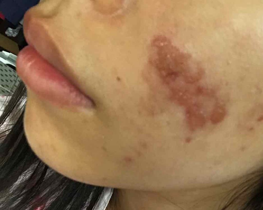 ニキビ治療薬クリーム (医薬品)/クレアラシル/その他を使ったクチコミ（2枚目）