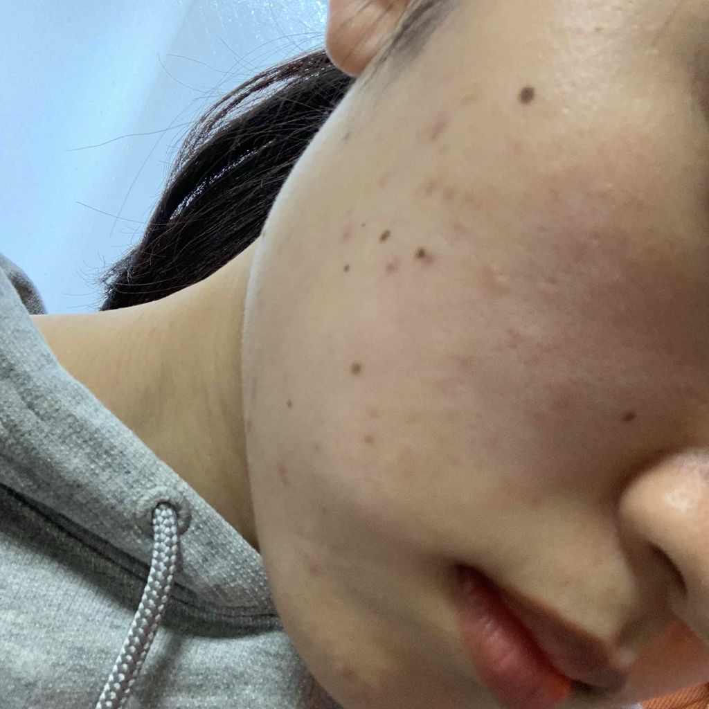 薬用 クリアローション M(しっとりタイプ)/オルビス/化粧水を使ったクチコミ（3枚目）