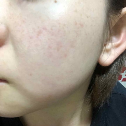 極潤 ヒアルロン液 ライトタイプ/肌ラボ/化粧水を使ったクチコミ(1枚目)