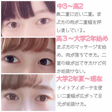 ナイトアイボーテ Streetrendの使い方を徹底解説 般若面から人間になった二重幅を広げる方法 By Tobibi 普通肌 代前半 Lips