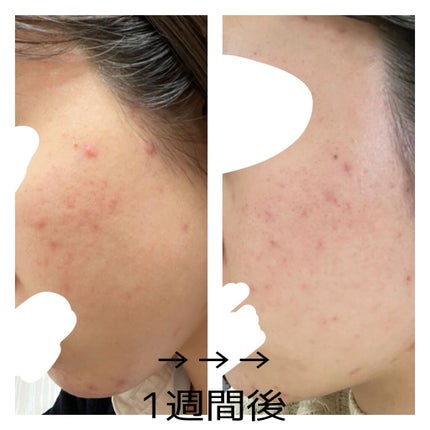 ディフェリンゲル0.1% /マルホ株式会社/その他を使ったクチコミ(3枚目)