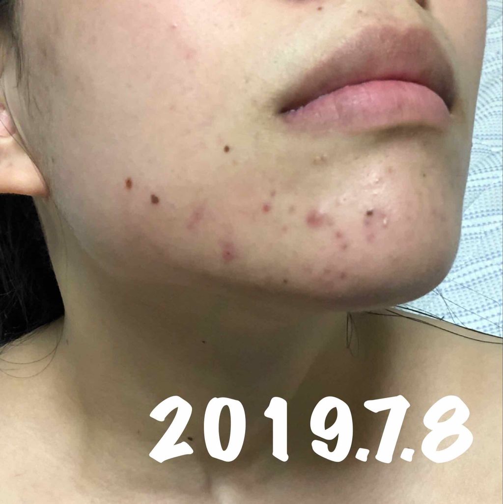 十味敗毒湯 ジュウミハイドクトウ(医薬品)/クラシエ薬品/その他を使ったクチコミ(3枚目)