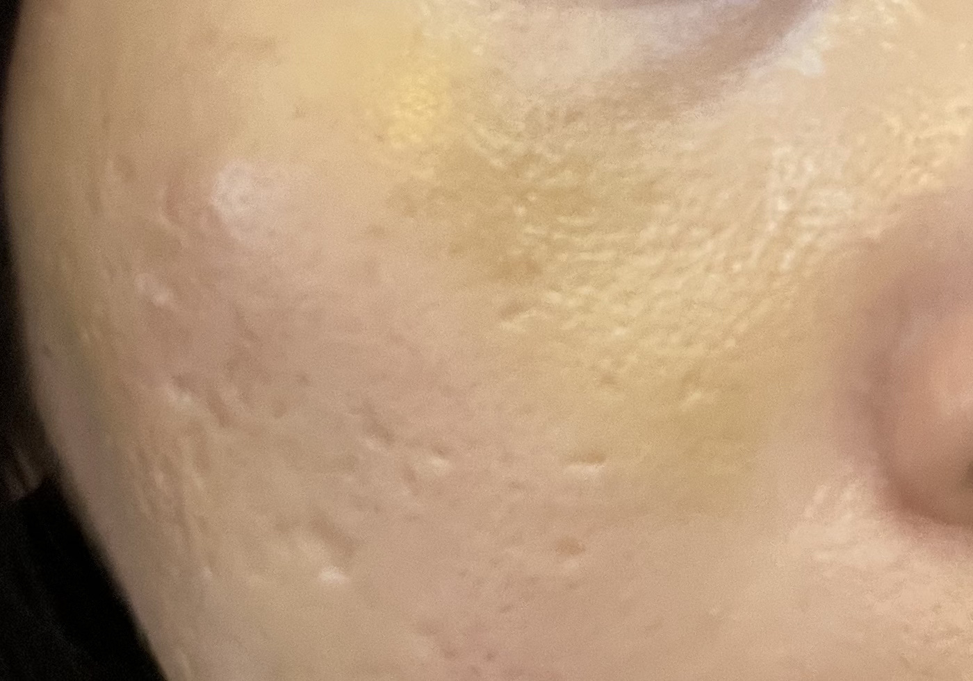 WHOMEE リキッドコンシーラーのクチコミ「転倒して顔面強打した際に頬骨周りに痣が出来てしまいました…

痣が青紫から黄色に変わった時、手.....」（3枚目）