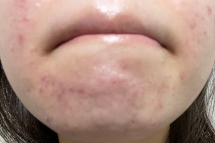 まままこ on LIPS 「ニキビゼロ肌を目指して〜6日目〜⚠️2枚目から肌画像ありスキン..」(4枚目)