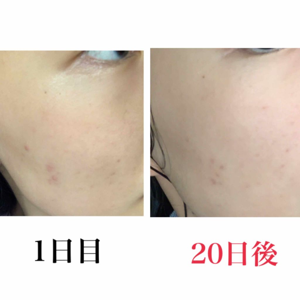 エバレッシュホワイトEXⅡ(医薬品)/matsukiyo/その他を使ったクチコミ（3枚目）