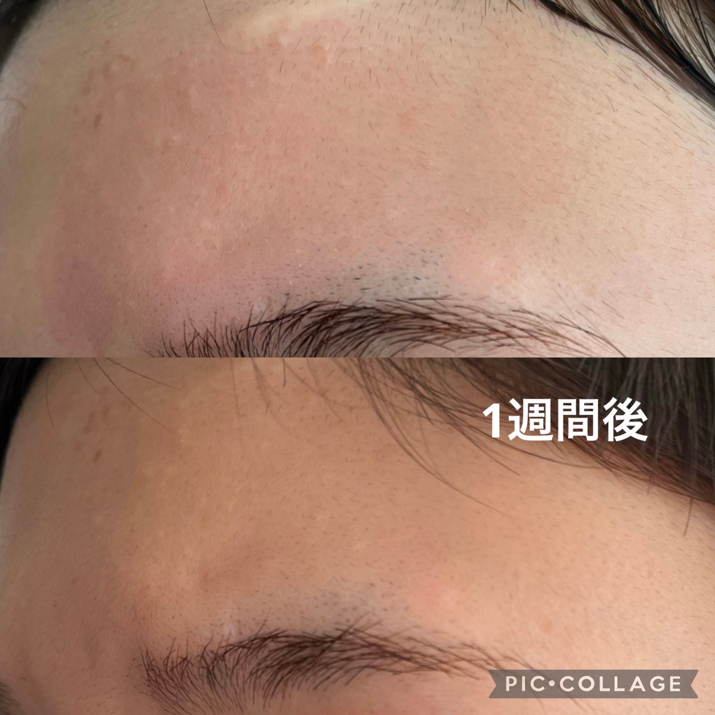 アクネケア セット MB/d プログラム/トライアルキットを使ったクチコミ(4枚目)