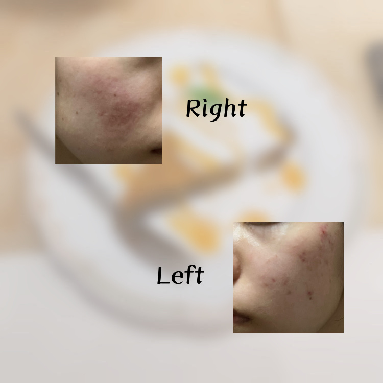 ハトムギ化粧水(ナチュリエ スキンコンディショナー R )/ナチュリエ/化粧水を使ったクチコミ（2枚目）