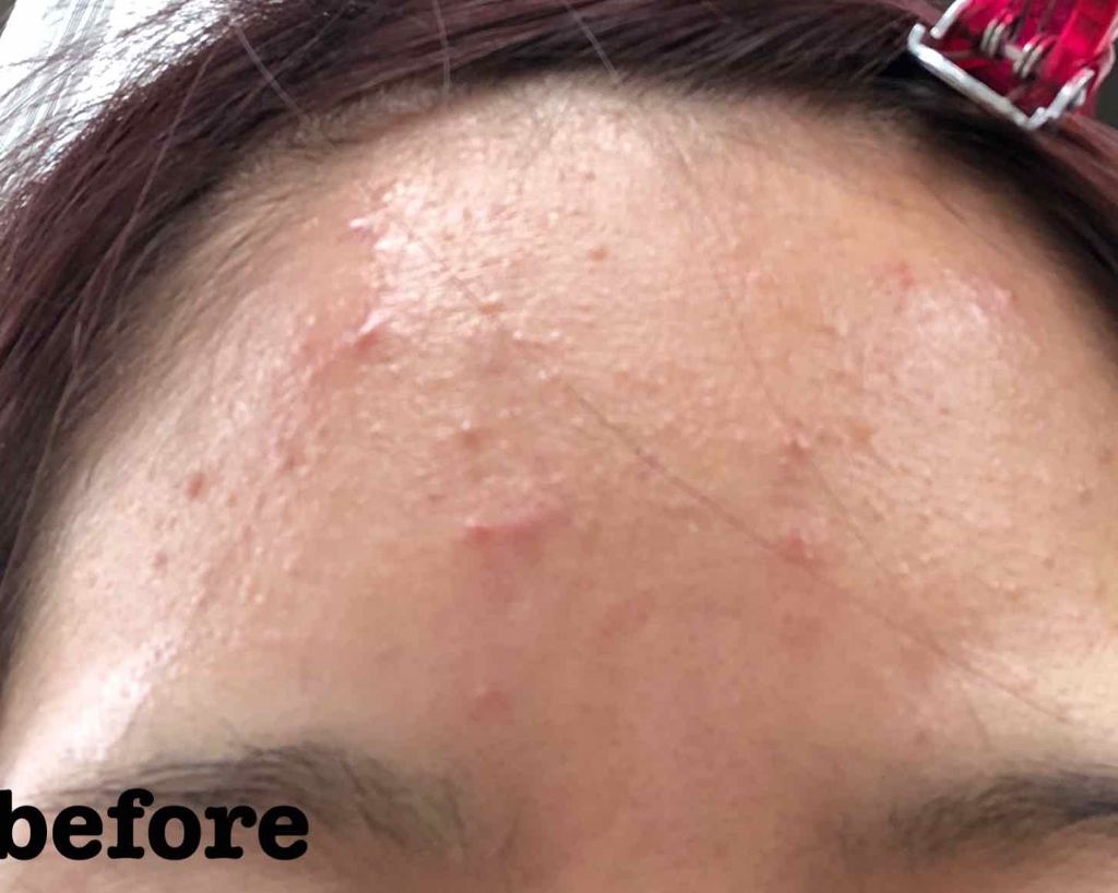 ペアアクネクリームW(医薬品)/ペア/その他を使ったクチコミ(2枚目)