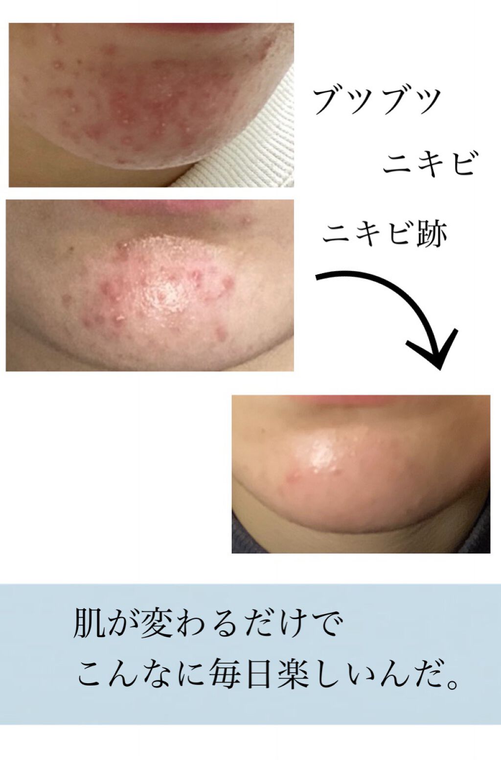 A アクネフォーム/NOV/洗顔フォームを使ったクチコミ(1枚目)