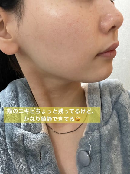 テラ・コートリル 軟膏(医薬品)/ジョンソン・エンド・ジョンソン/その他を使ったクチコミ(4枚目)