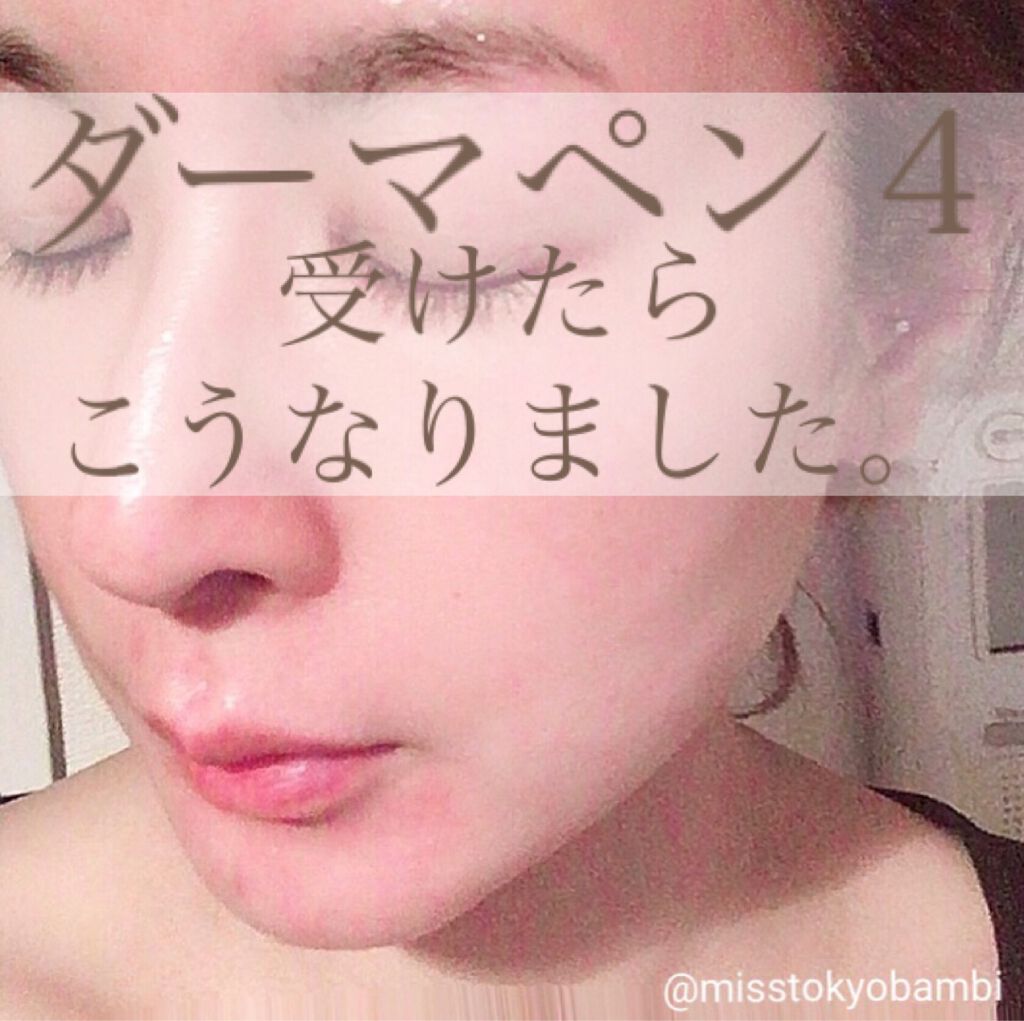 白ゆり@美容ブロガー on LIPS 「湘南美容外科でダーマペン4を受けてきたその後🙋🏻♀️✨୨୧┈..」(1枚目)