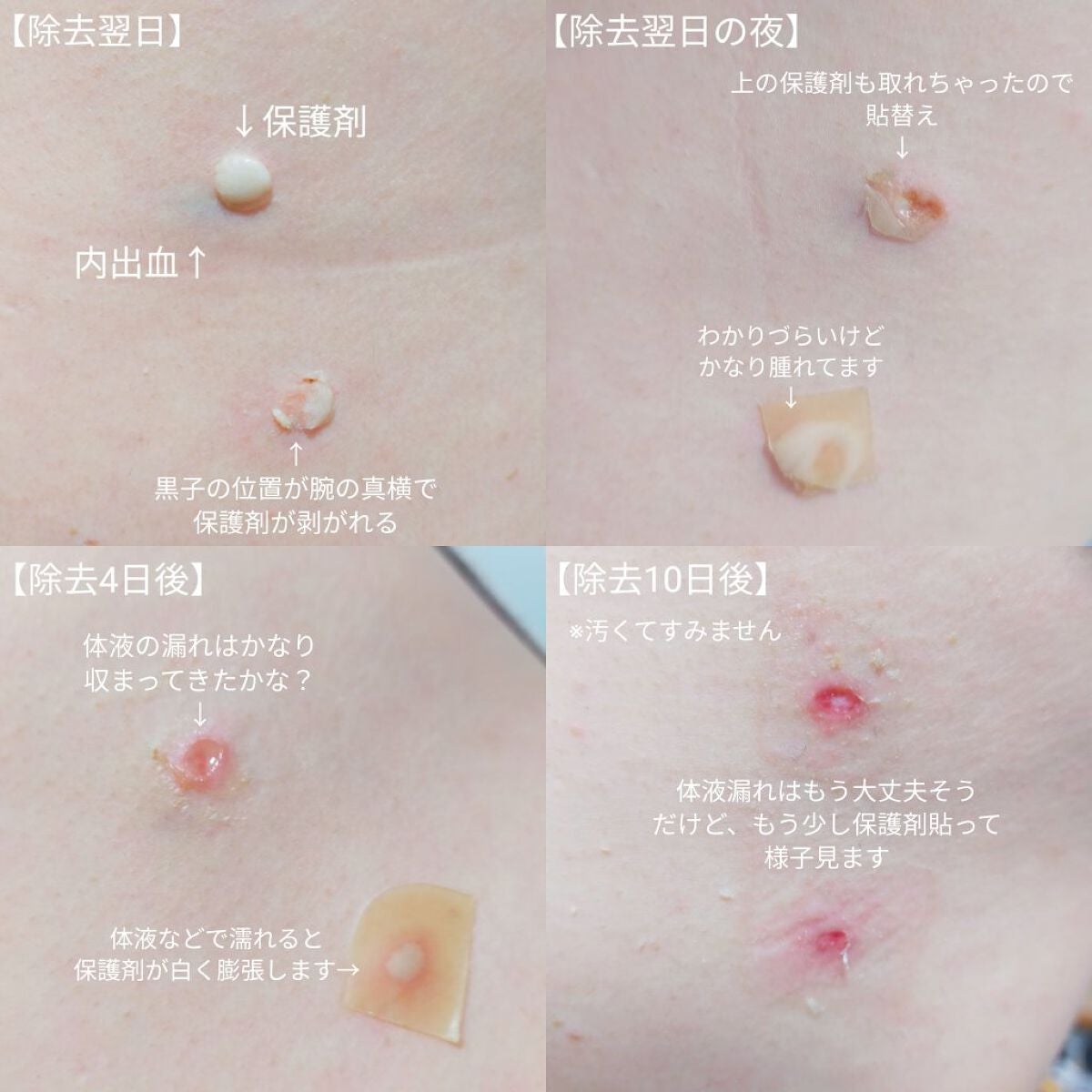 敏感肌な研究者💊あすか💊 on LIPS 「#ホクロをレーザーで除去したお話の経過報告です⚠️患部の写真が..」(4枚目)