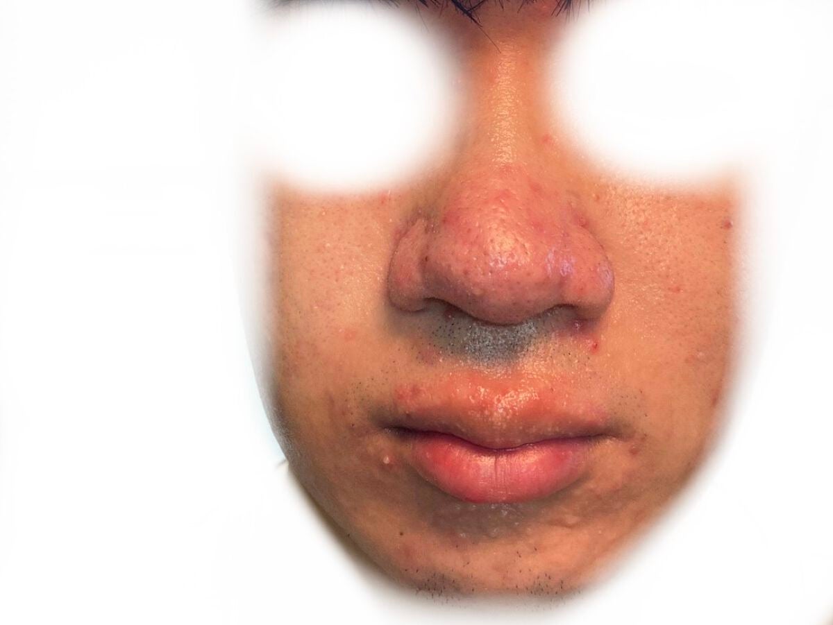 (フォロバ)3年後に韓国美男子 on LIPS 「CICA×HYALONフェスパック最終レビュー1ヶ月の経過写真..」(6枚目)