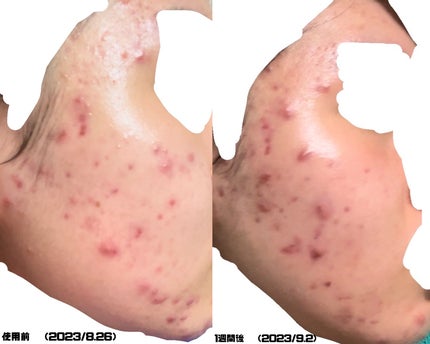 みこ on LIPS 「【ニキビ治療経過記録】閲覧注意です!!小学生の頃からニキビに悩..」(5枚目)