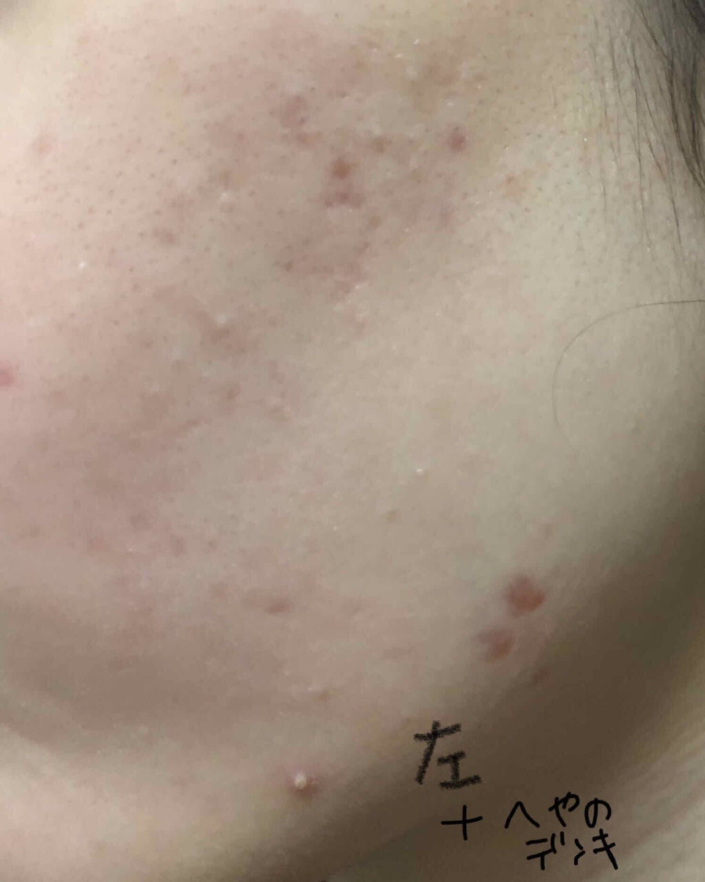 最近は無駄遣い女 on LIPS 「そういえば何ヶ月経ったか忘れちゃったけどビハクエンの経過。半年..」(2枚目)