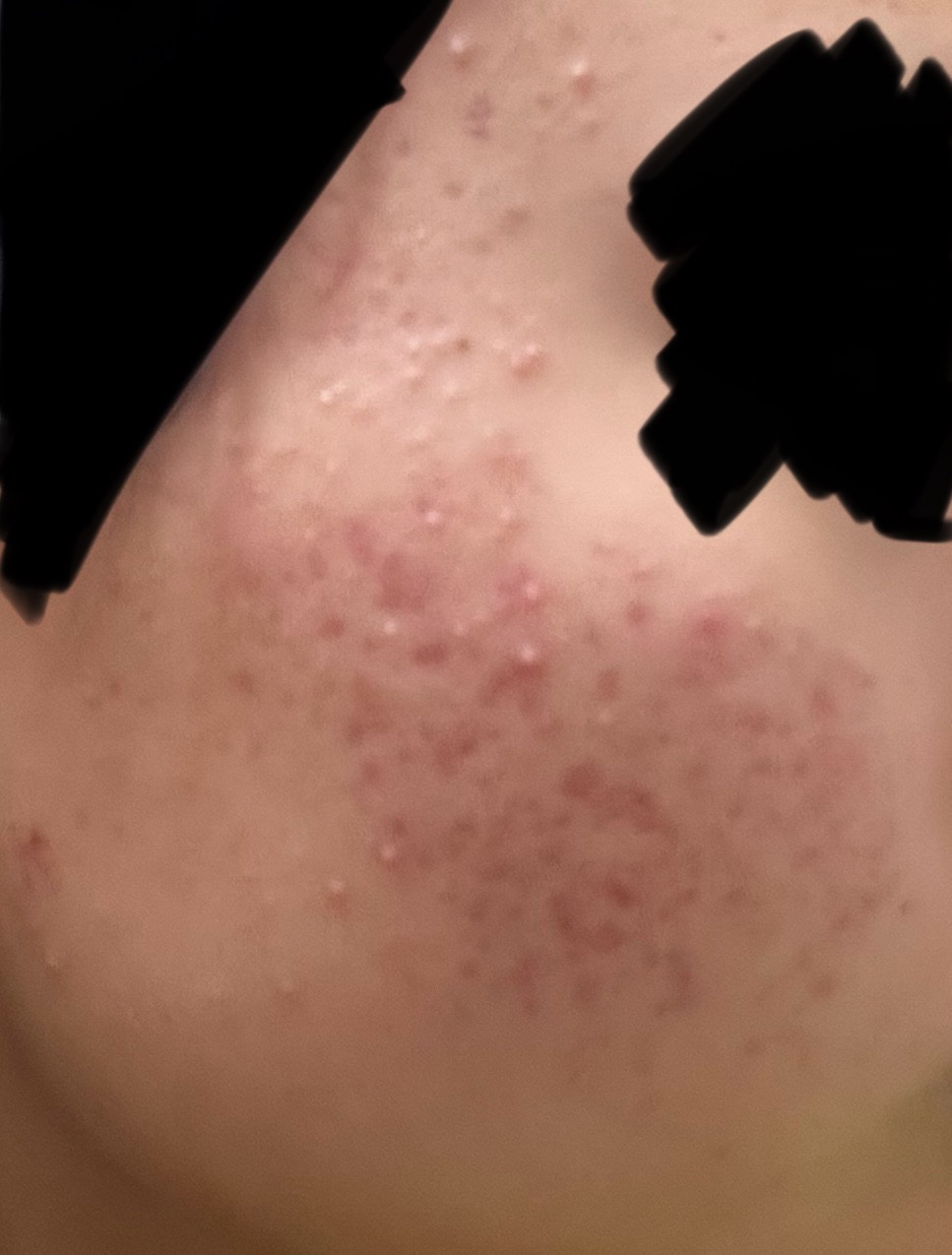 薬用しみ集中対策 プレミアム美容液/メラノCC/美容液を使ったクチコミ（2枚目）