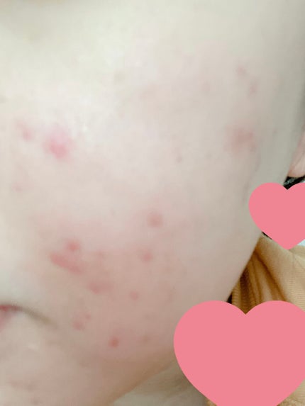 オロナインH軟膏 (医薬品)/オロナイン/その他を使ったクチコミ(1枚目)