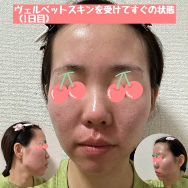 すみれ"25歳美容部員" on LIPS 「今日はダーマペンとオプションのヴェルベットスキンを受けてきまし..」（3枚目）