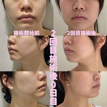 Tomomi on LIPS 「はじめての美容医療〜脂肪溶解リニアHIFU〜2回目施術後0日目..」（4枚目）