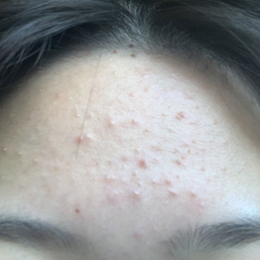 オードムーゲ 薬用ローション（ふきとり化粧水）/オードムーゲ/拭き取り化粧水を使ったクチコミ（2枚目）