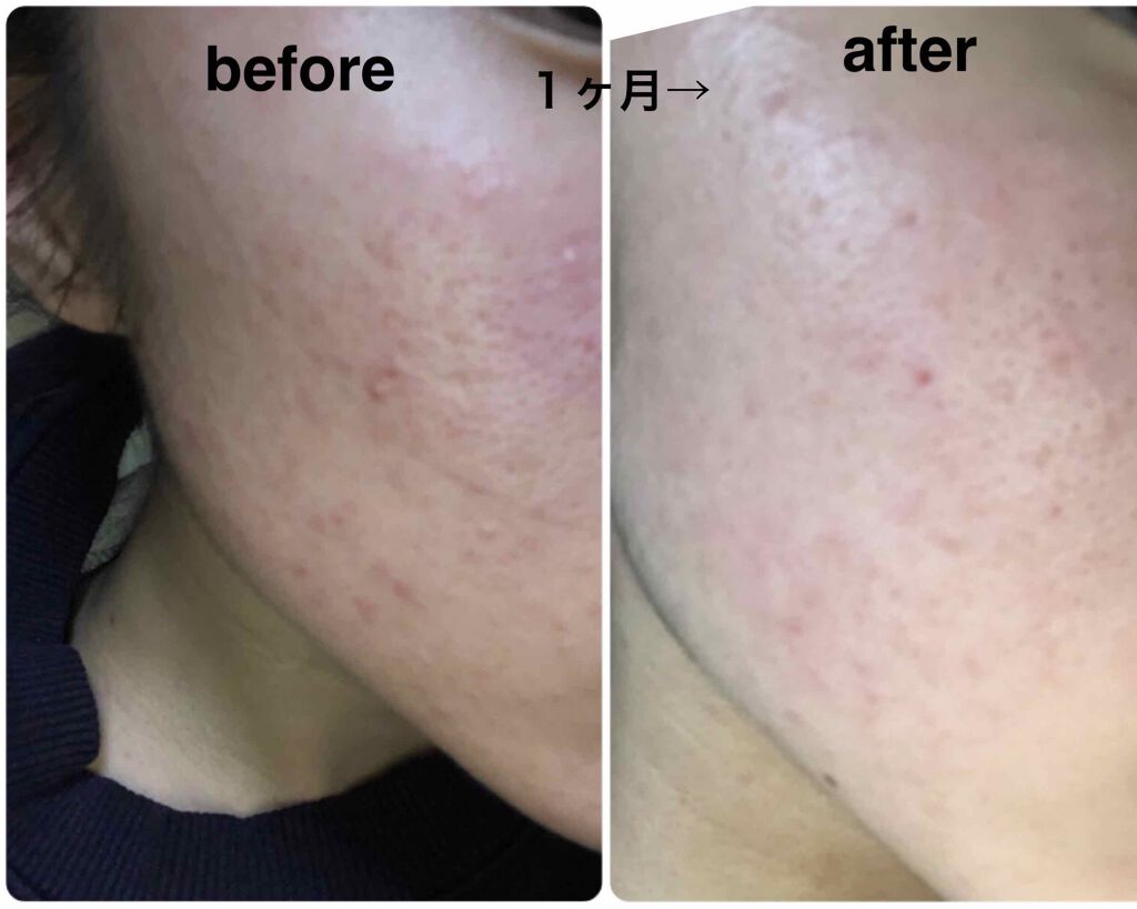 ベピオゲル/マルホ株式会社/その他を使ったクチコミ（2枚目）