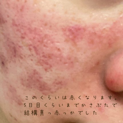 品川スキンクリニック/ノーブランド/その他を使ったクチコミ(2枚目)