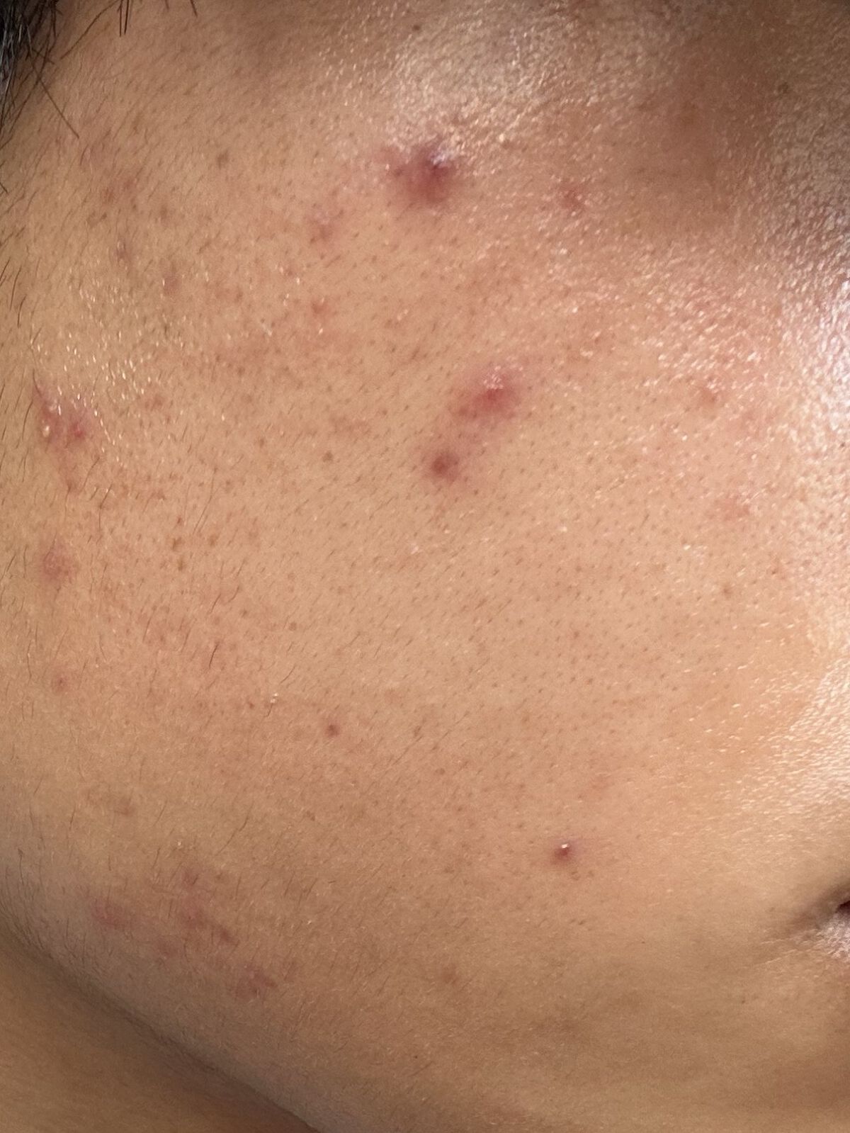 薬用しみ集中対策 プレミアム美容液/メラノCC/美容液を使ったクチコミ（1枚目）