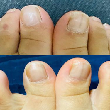 クリアネイルショット アルファ 北の快適工房の口コミ 濁り爪北の快適工房クリアネイルショットアル By Pikopiko 乾燥肌 Lips