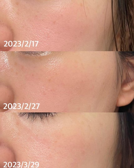 あずさ@スキンケアマニア on LIPS 「薄いシミは消えるのか?ピコスポットレポ1月半ばにUBクリニック..」(6枚目)