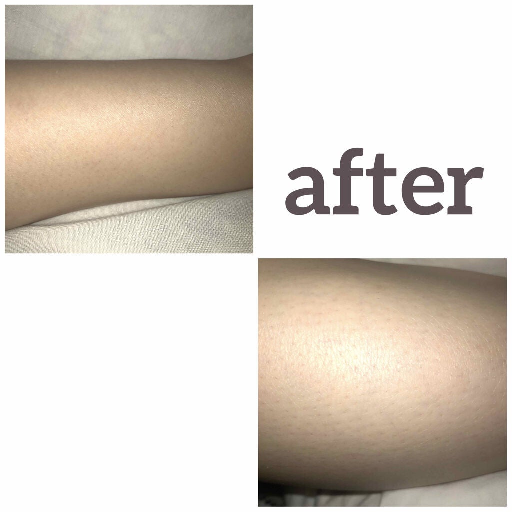 beyda IPL光脱毛器/beyda/家庭用脱毛器を使ったクチコミ(2枚目)