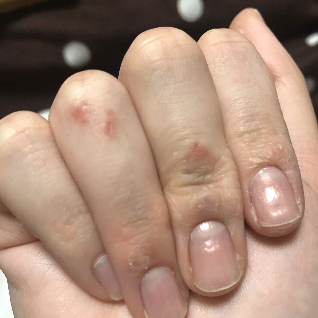 ヘパリン類似物質 油性クリーム0.3%「日医工」/日医工ファーマ/その他スキンケアを使ったクチコミ（2枚目）