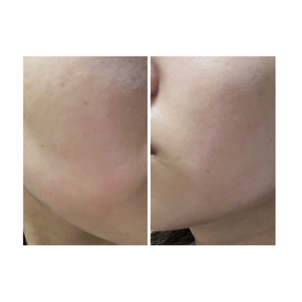 ぽむ on LIPS 「2023.9.13皮膚科に受診 エピデュオとヘパリン処方1枚目..」(3枚目)