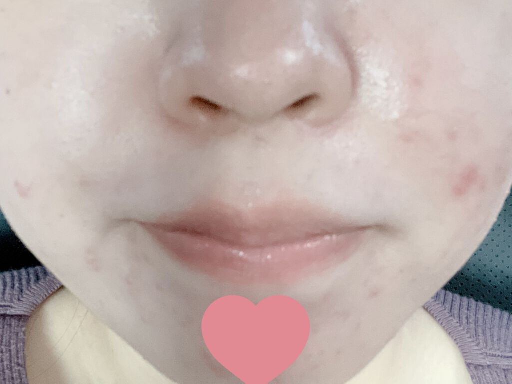 アクネケアローション W/d プログラム/化粧水を使ったクチコミ（1枚目）