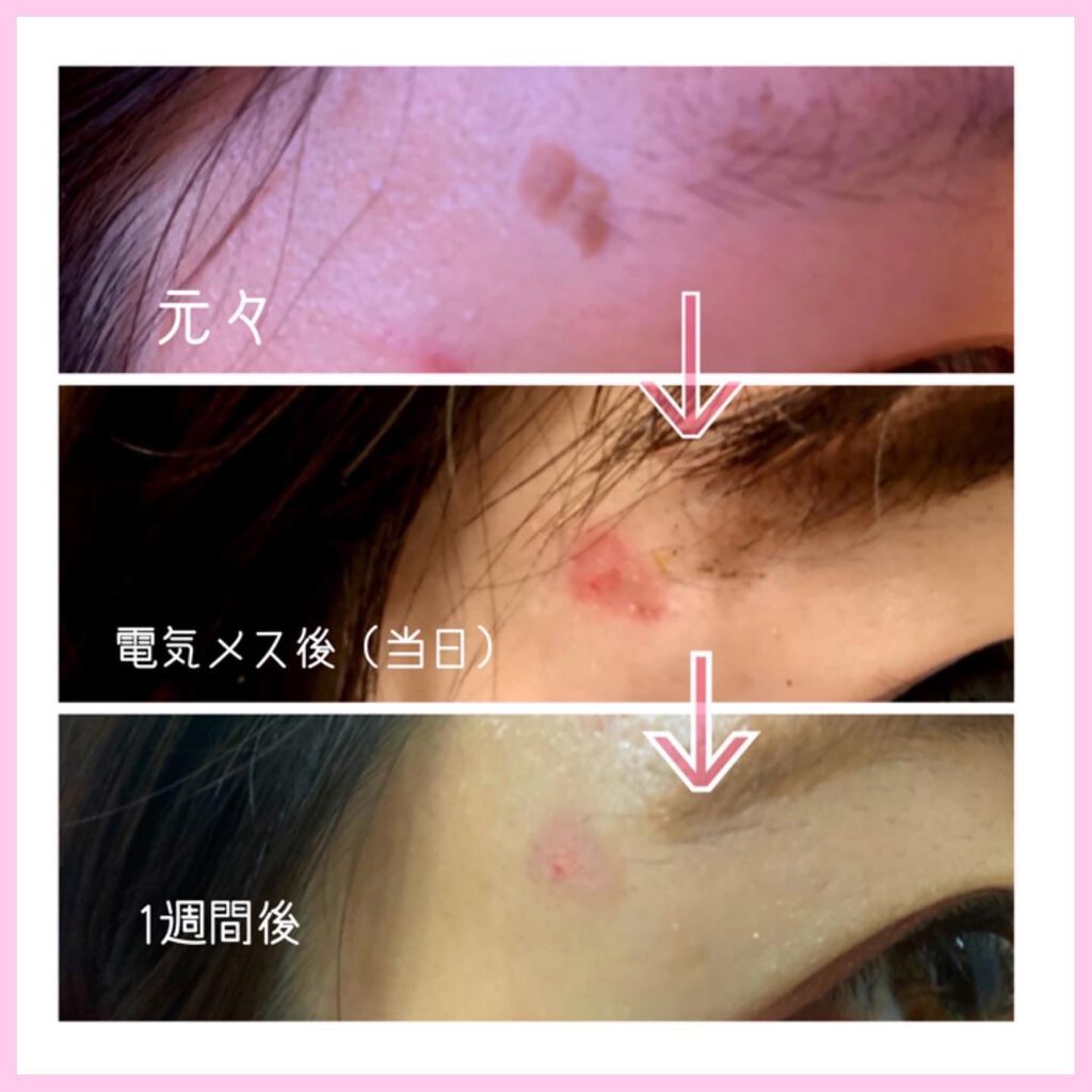 Sちゃん@歯列矯正 フォロバ on LIPS 「𓇼美容皮膚科編のpart2ですー!part1からご覧ください!..」(3枚目)