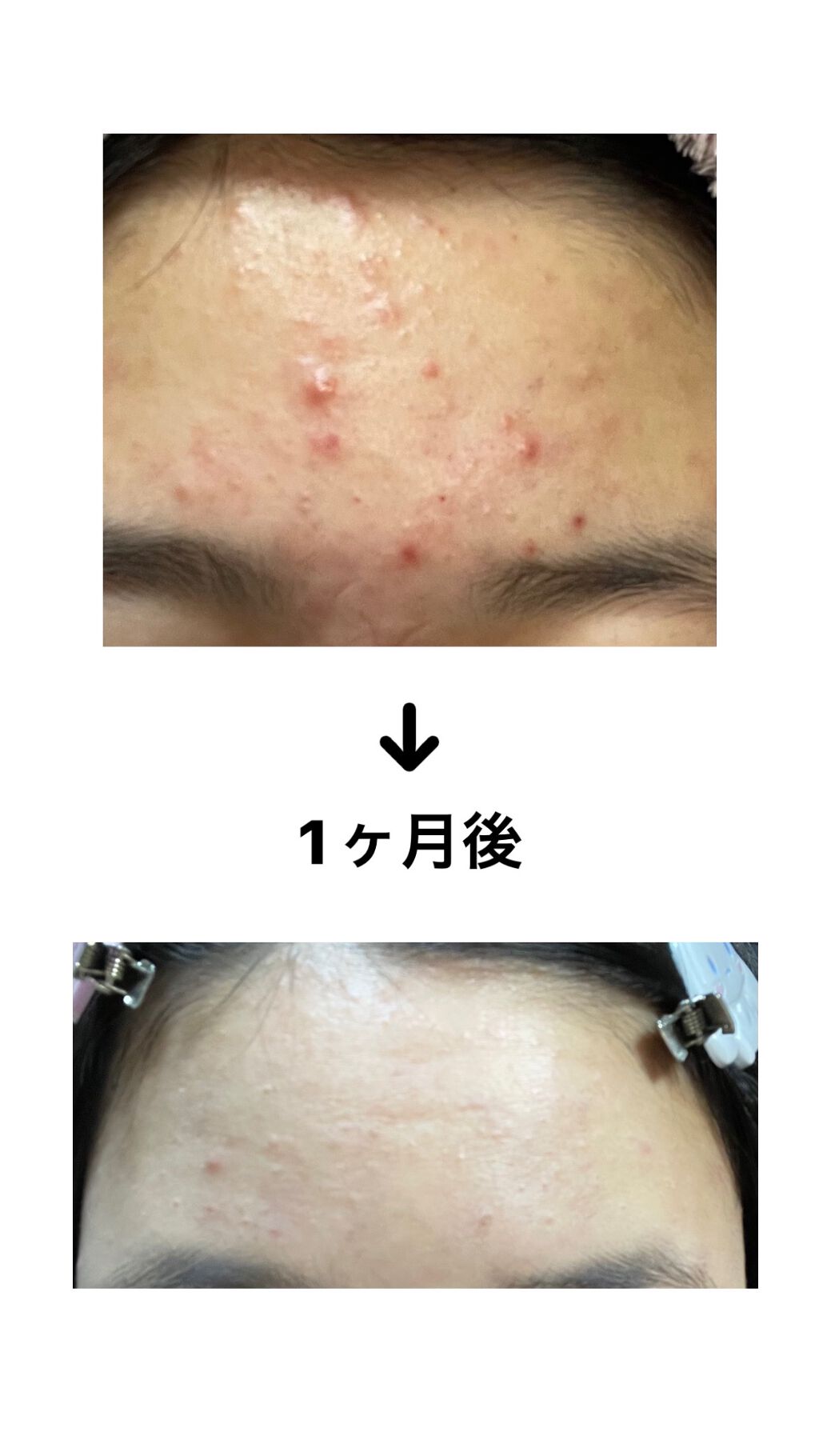 ハトムギ化粧水(ナチュリエ スキンコンディショナー R )/ナチュリエ/化粧水を使ったクチコミ(2枚目)