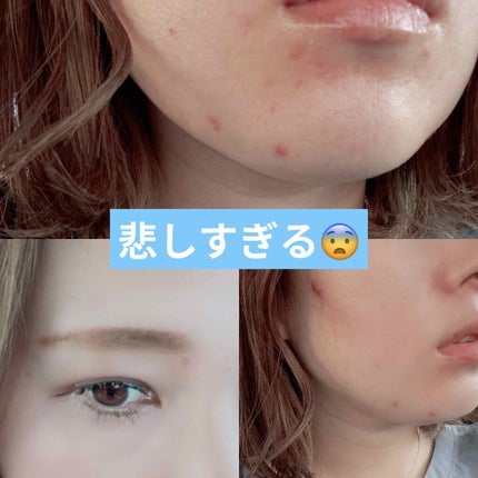 ディフェリンゲル0.1% /マルホ株式会社/その他を使ったクチコミ(1枚目)