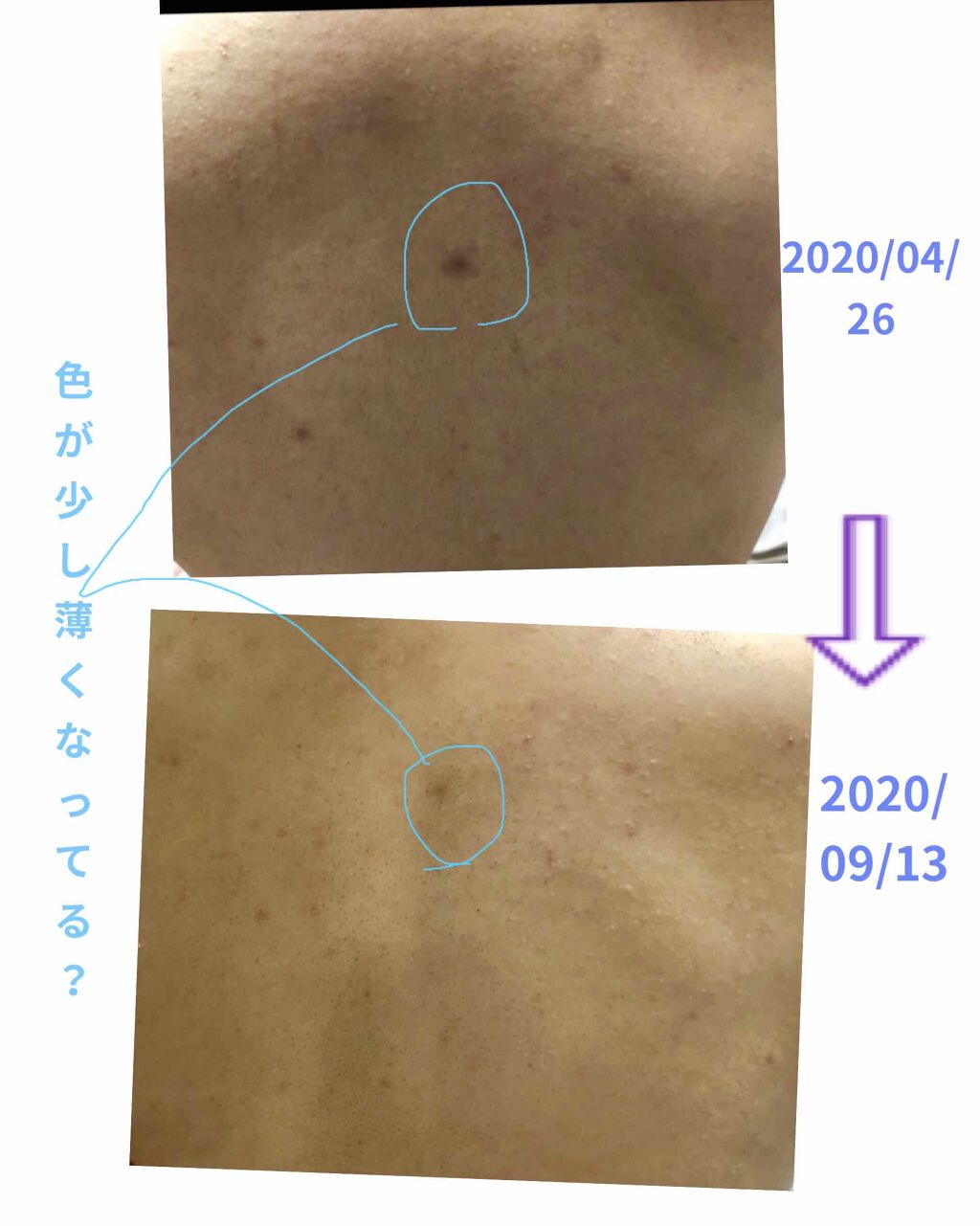 薬用パウダー化粧水/メンソレータム アクネス/化粧水を使ったクチコミ（2枚目）