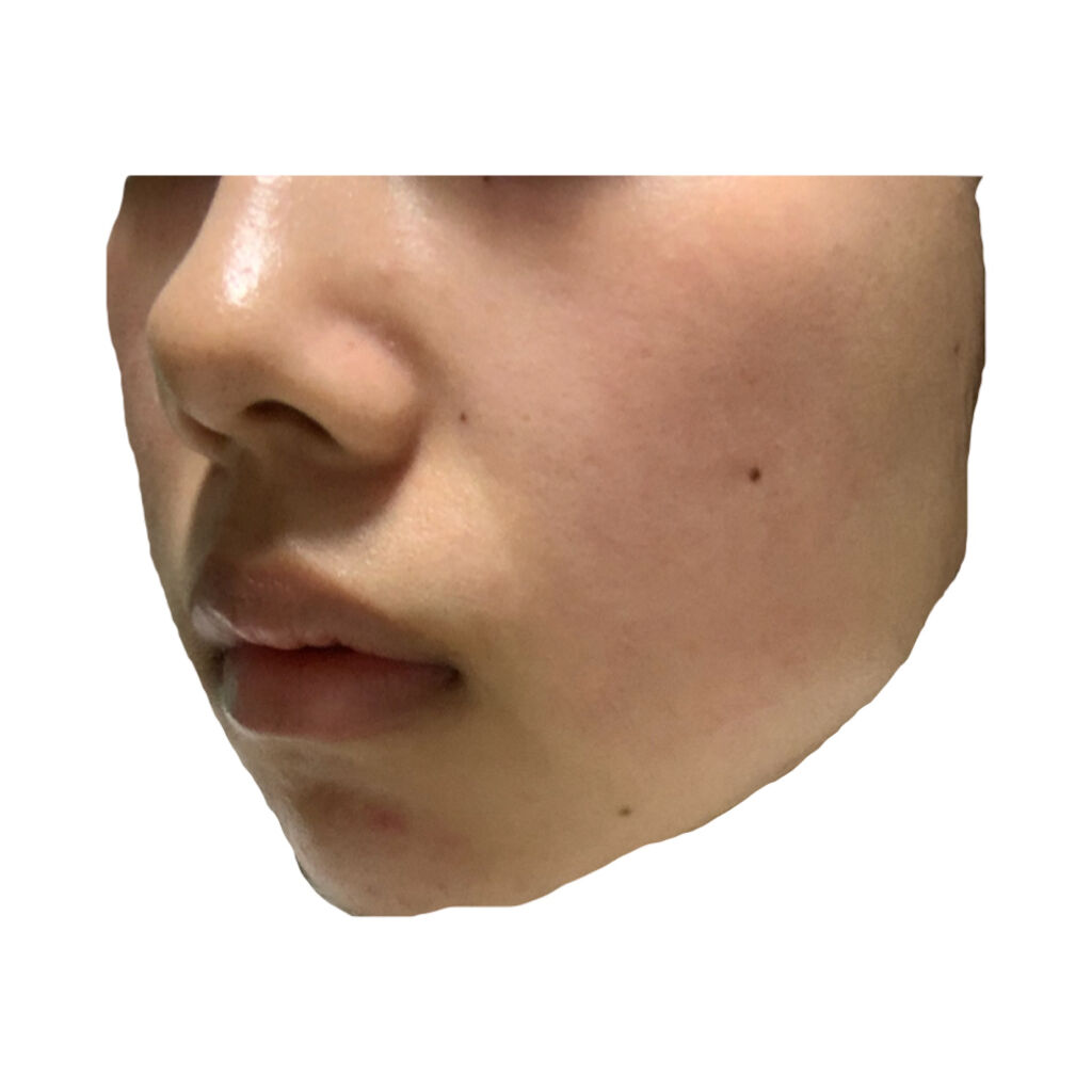 ベピオゲル/マルホ株式会社/その他を使ったクチコミ（2枚目）