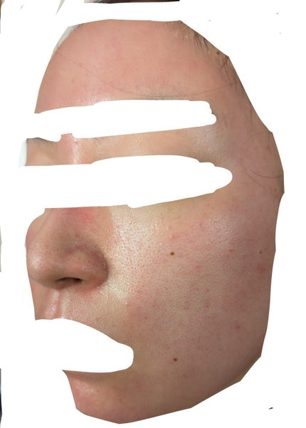 れれ on LIPS 「前情報:顔脱毛は1回しかまだ完了してません品川美容皮膚科でフラ..」(4枚目)