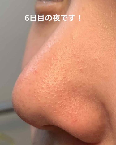 さやぁ on LIPS 「黒い点々は無くなった気がします！肌が弱いため、朝は水だけで洗い..」（1枚目）