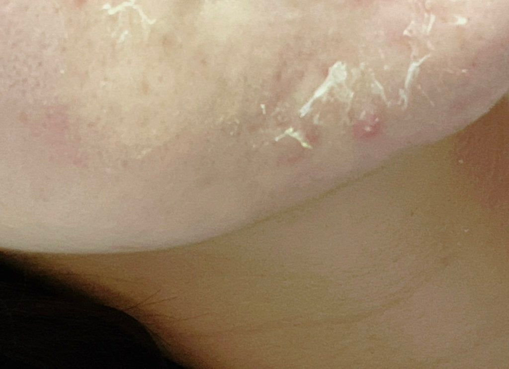 レチノールA 1% アドバンスドリバイタリゼーションクリーム/Life-flo/フェイスクリームを使ったクチコミ(3枚目)