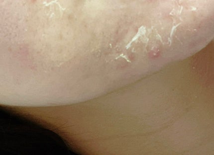 レチノールA 1% アドバンスドリバイタリゼーションクリーム/Life-flo/フェイスクリームを使ったクチコミ(3枚目)