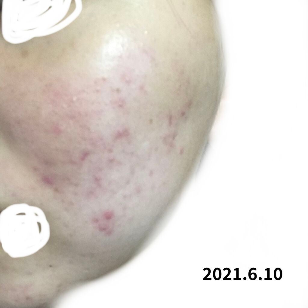 ããã¯ãªð°ðž on LIPS ã仿¥ãzoomææ¥é 匵ããŸããïŒãä»äºåŠæ ¡ãã®ä»è«žã
ã¿ãªããã..ãïŒ2æç®ïŒ