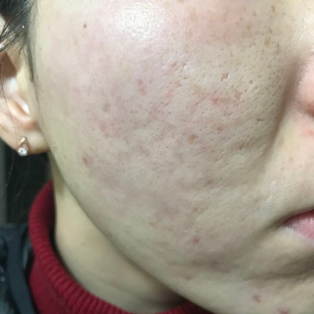 ティーツリーケア ソリューション エッセンシャルマスクEX/MEDIHEAL/シートマスク・パックを使ったクチコミ(1枚目)